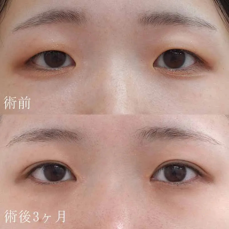 二重切開法+目頭切開の症例写真