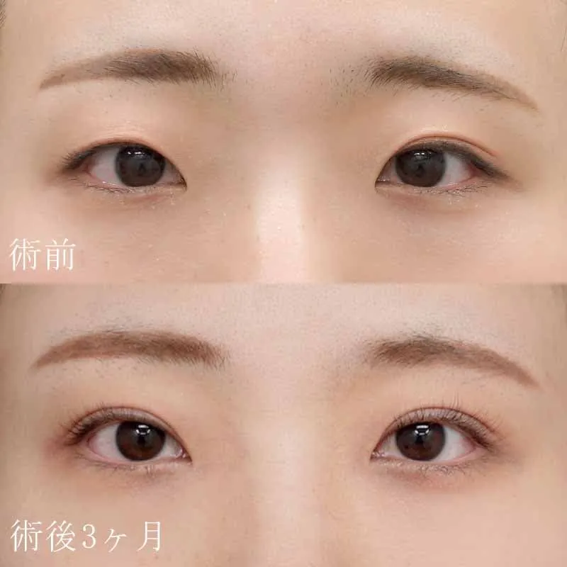 二重切開法+目頭切開の症例写真