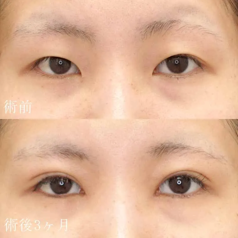 二重切開法+目頭切開の症例写真