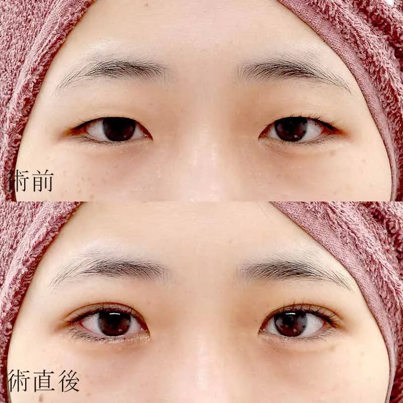二重埋没法の症例写真
