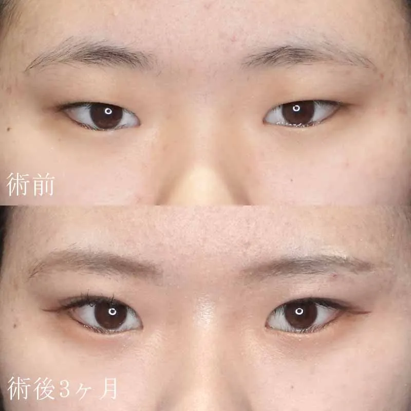 二重切開法の症例写真