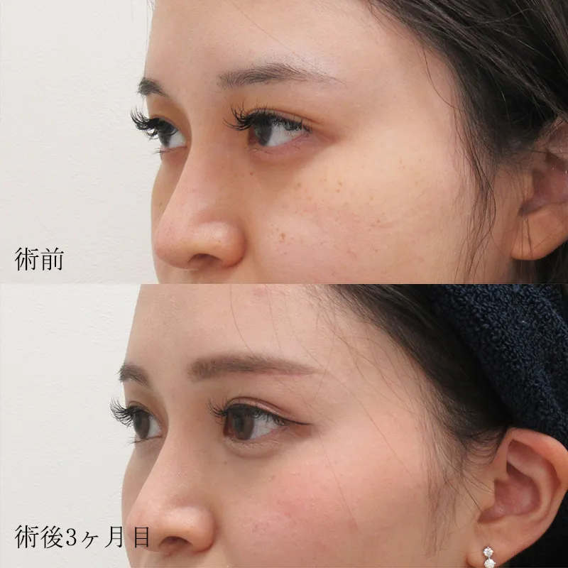 眉下切開の症例写真