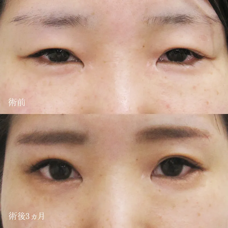 眉下切開の症例写真