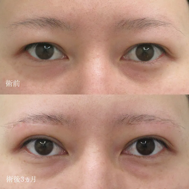 眉下切開の症例写真