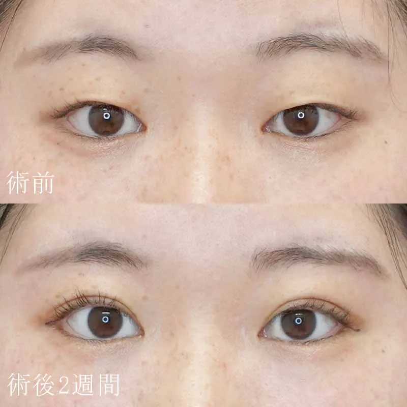 二重埋没法の症例写真