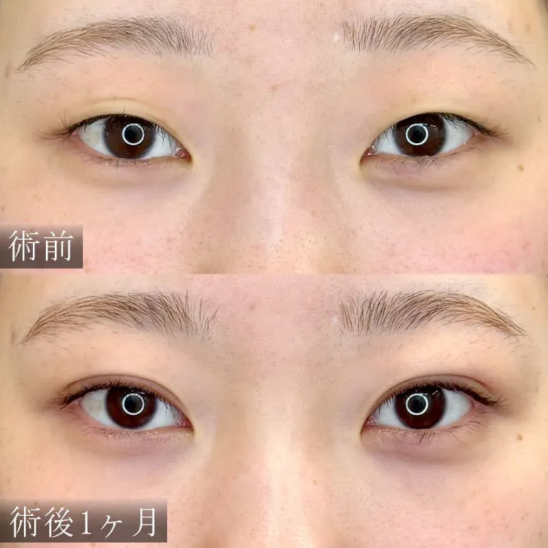 自然癒着法の症例写真