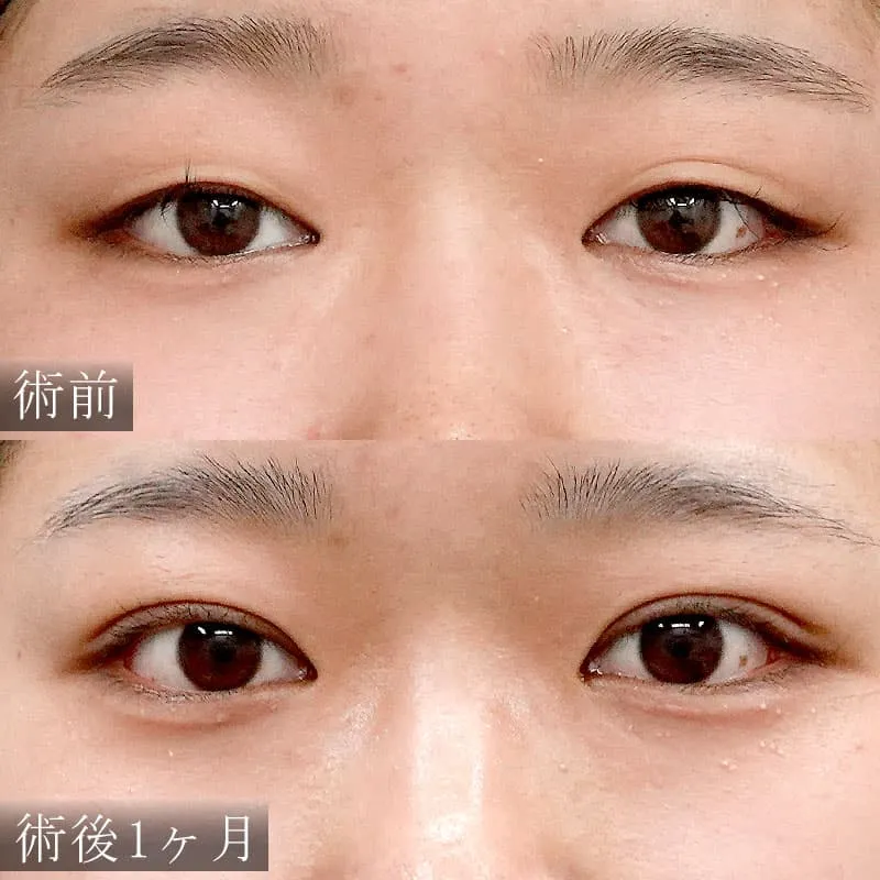 自然癒着法の症例写真