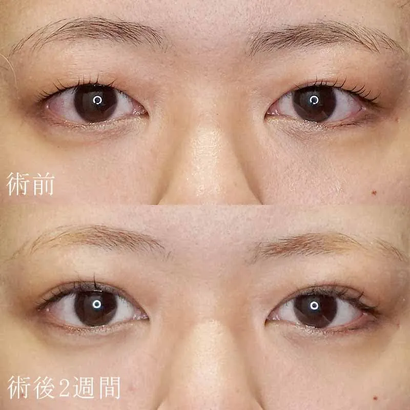 二重埋没法で一重を二重にした例
