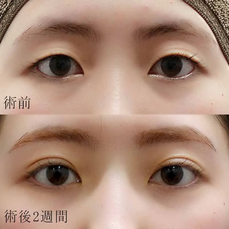 二重埋没法で一重を二重にした例