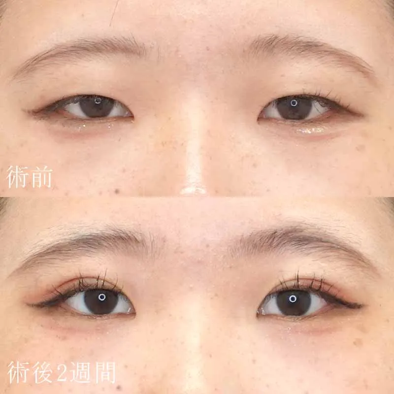 二重埋没法で一重を二重にした例