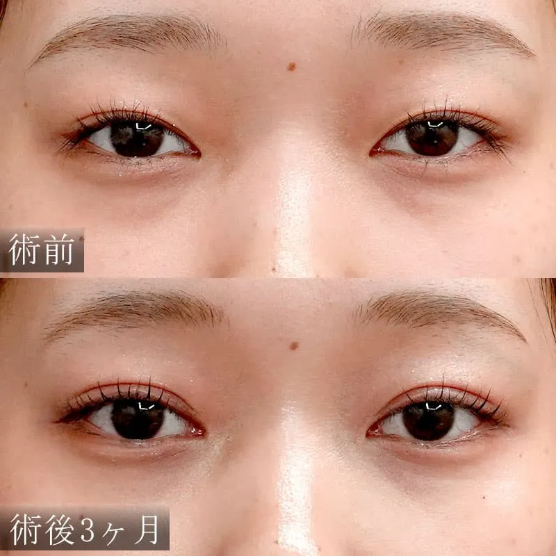 小糸症例写真
