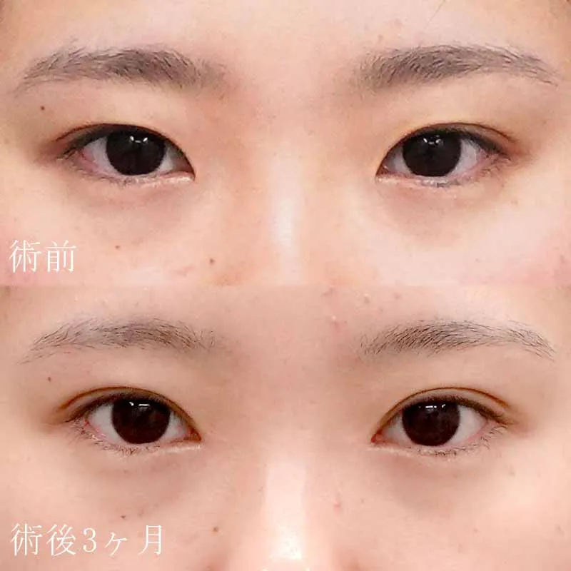 二重埋没法＋目頭切開法2
