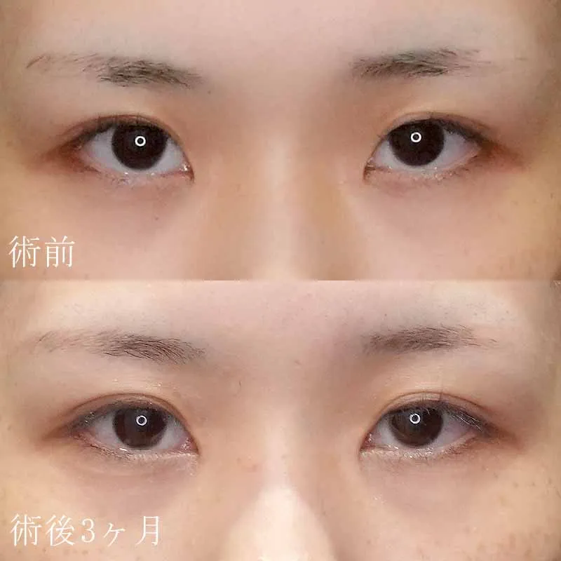 二重埋没法＋目頭切開法3