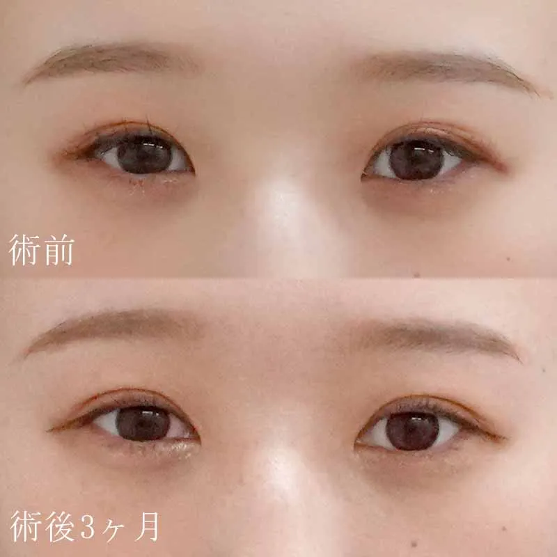 二重埋没法＋目頭切開法4