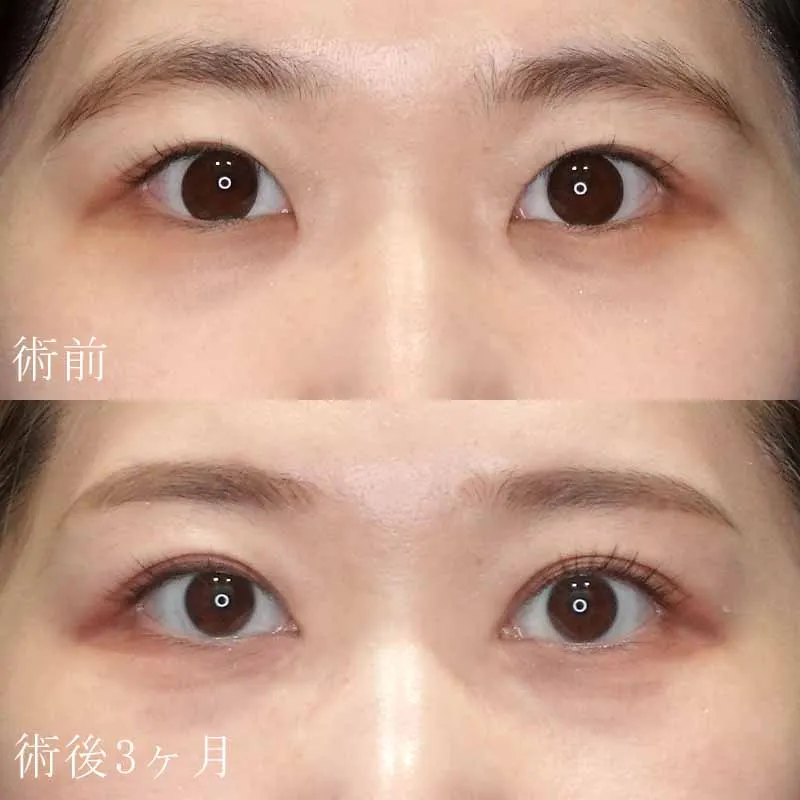 二重埋没法＋目頭切開法5