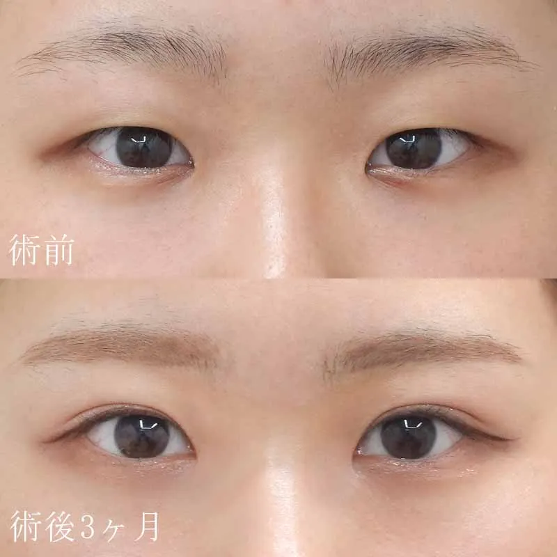 二重埋没法＋目頭切開法6