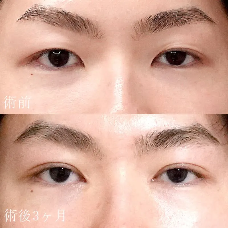二重埋没法+目頭切開法3