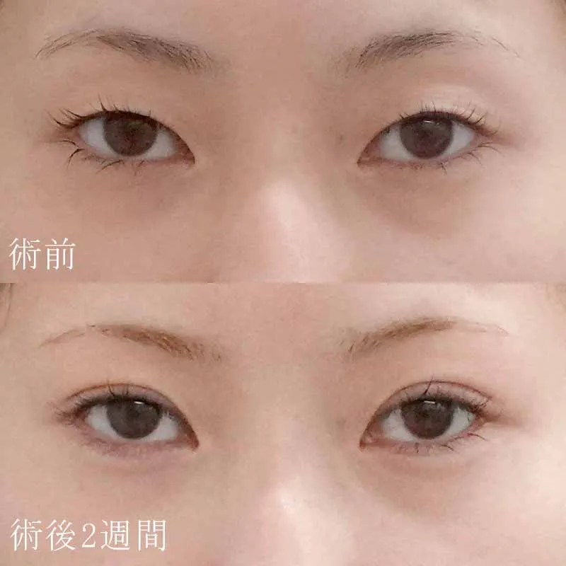 二重埋没法＋目頭切開法5