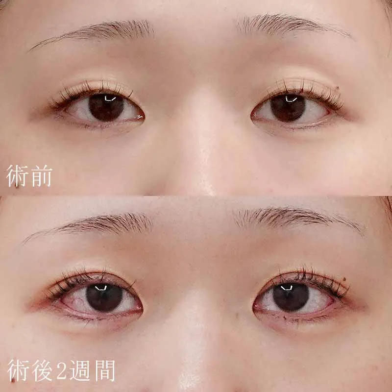 二重埋没法＋目頭切開法1