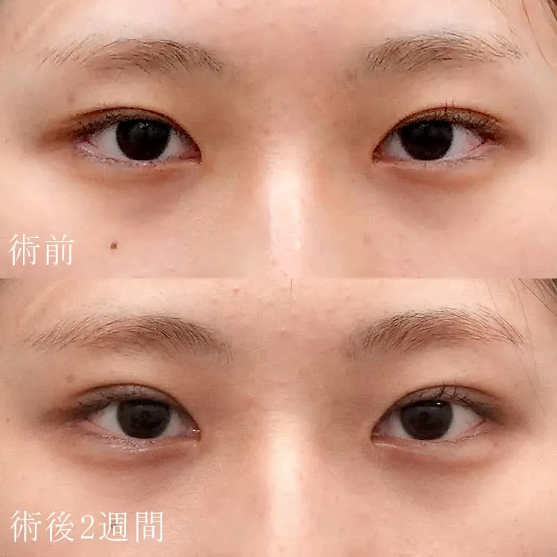 二重埋没法＋目頭切開法3