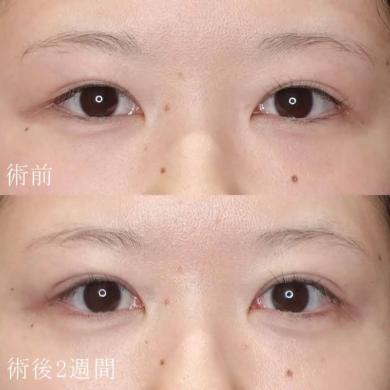 二重埋没法＋目頭切開法2