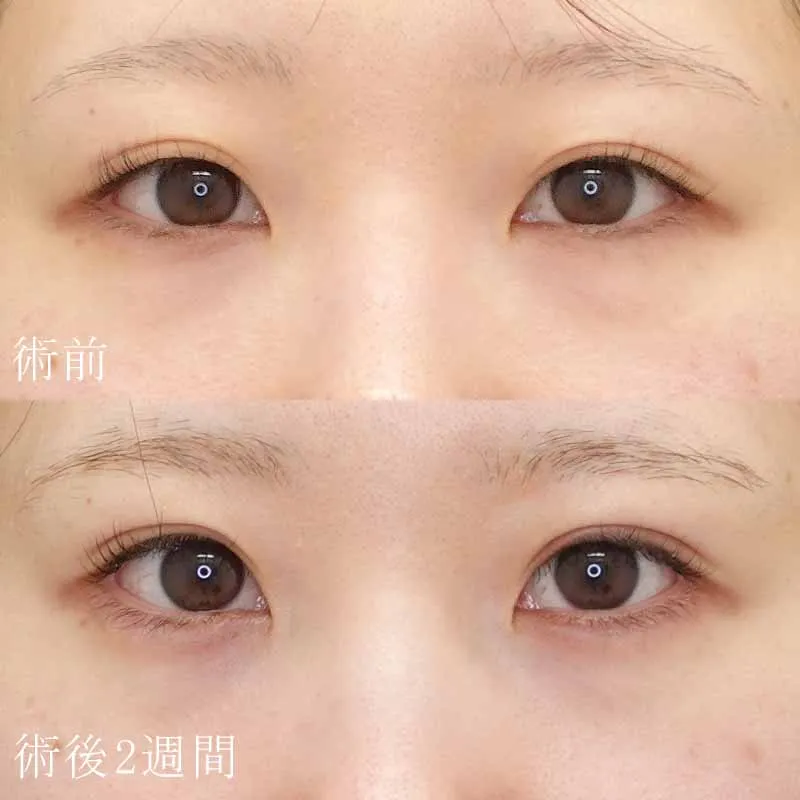 二重埋没法＋目頭切開法4