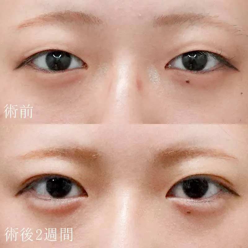 二重埋没法＋目頭切開法5
