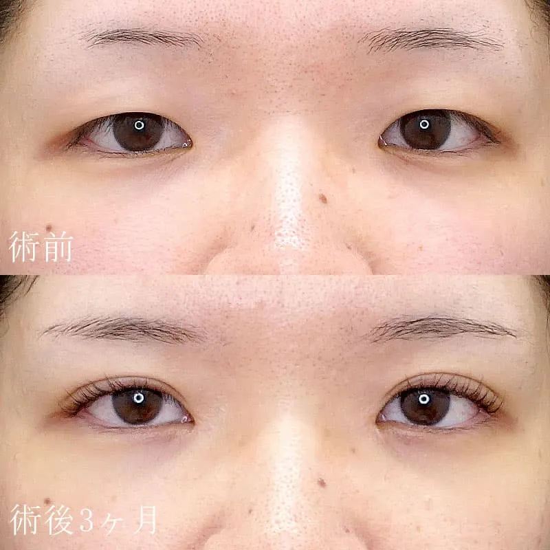 二重埋没法+目頭切開法6
