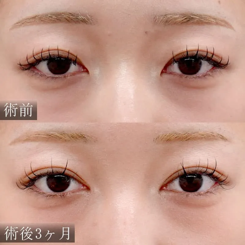 二重埋没法＋目頭切開法