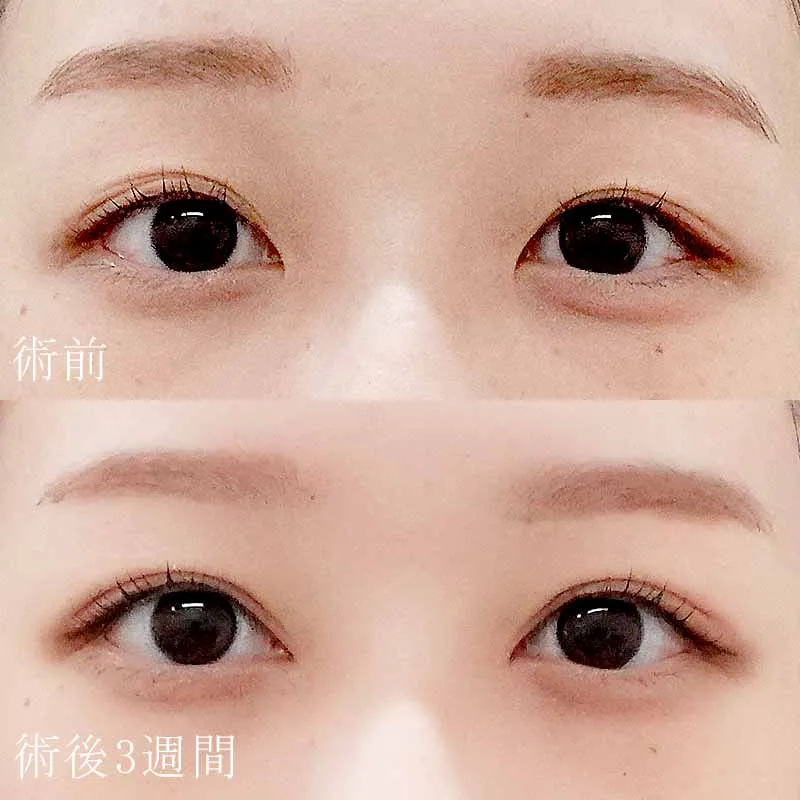 二重埋没法＋目頭切開法