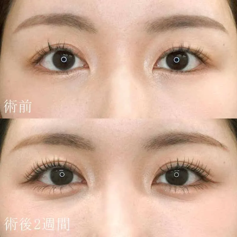 二重埋没法＋目頭切開法