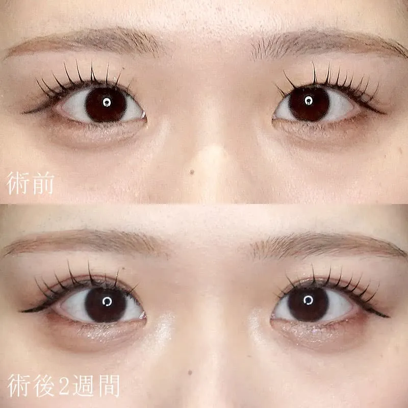 二重埋没法＋目頭切開法