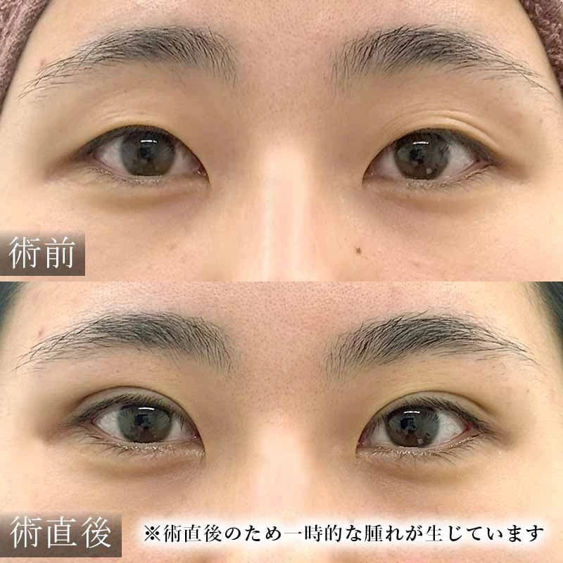 二重埋没法で一重を二重にした例