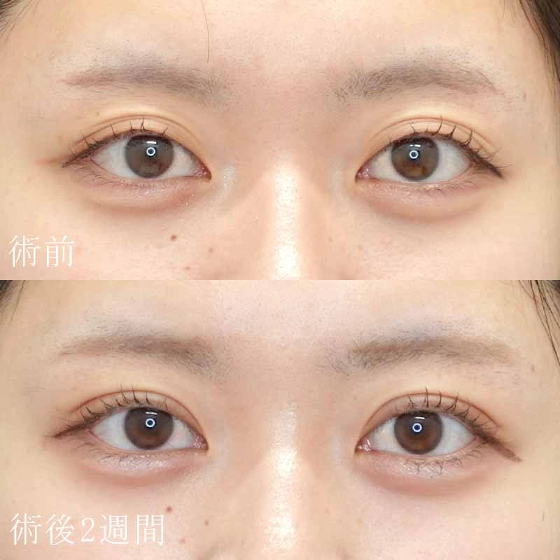 二重埋没法で一重を二重にした例