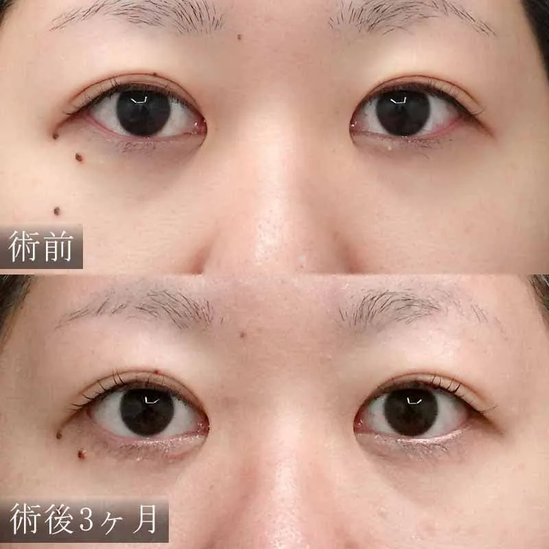 目尻切開の症例写真②