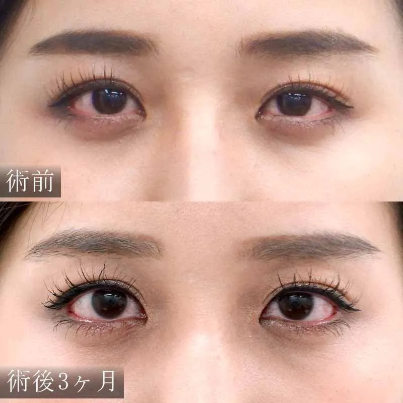 目尻切開の症例写真②