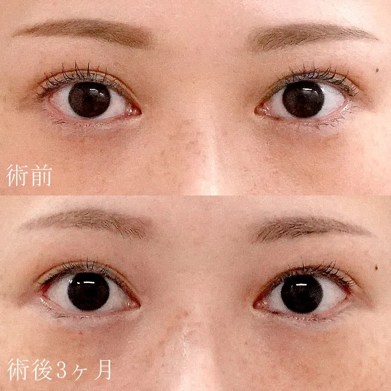 目尻切開の症例写真②