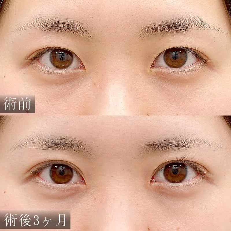 平行型の二重