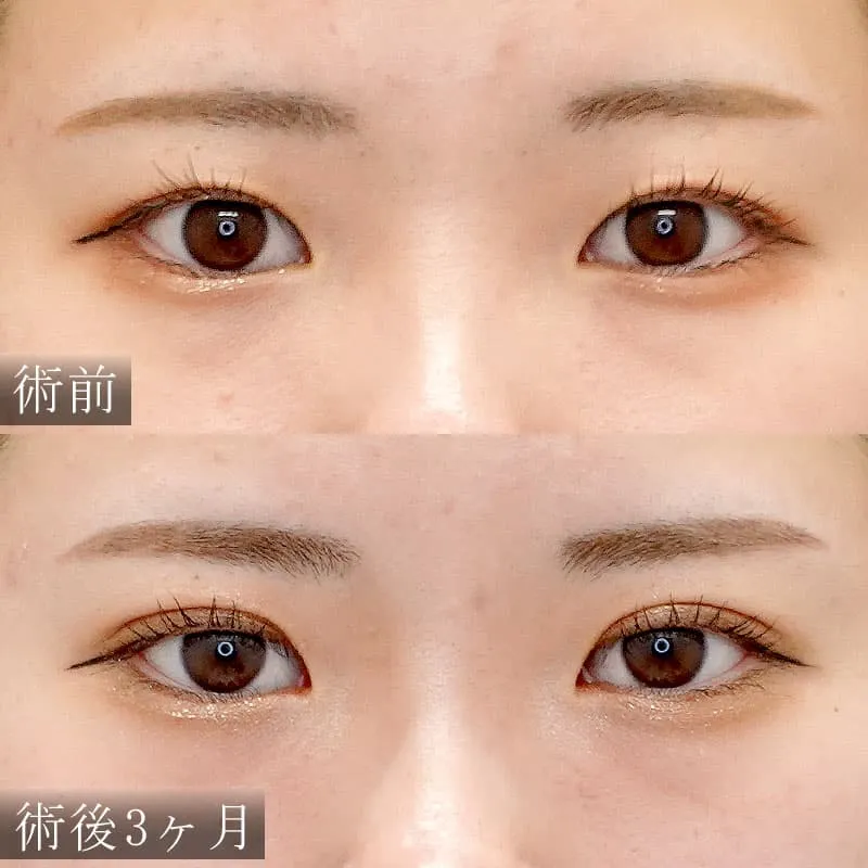 末広型の二重