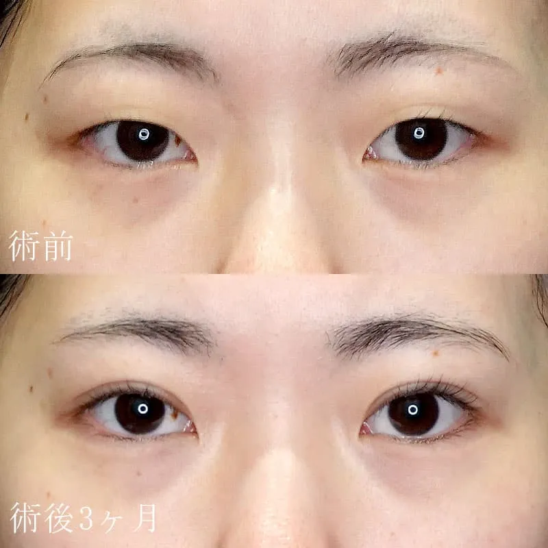 二重切開法の症例写真