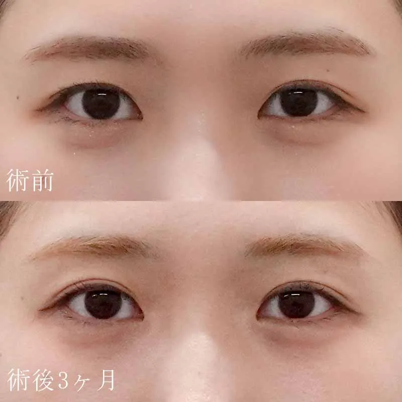 二重切開法の症例写真