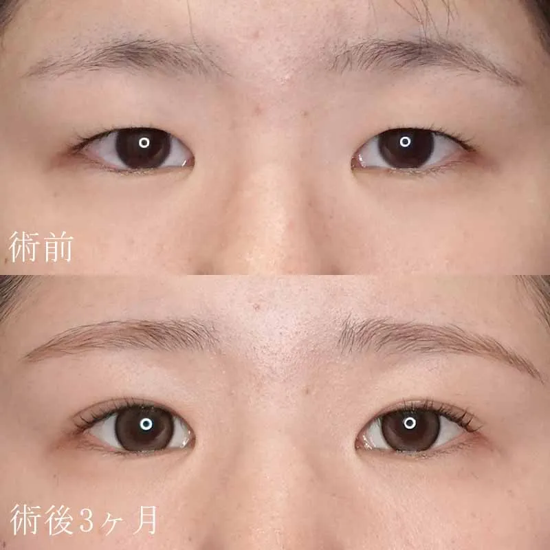二重切開法の症例写真