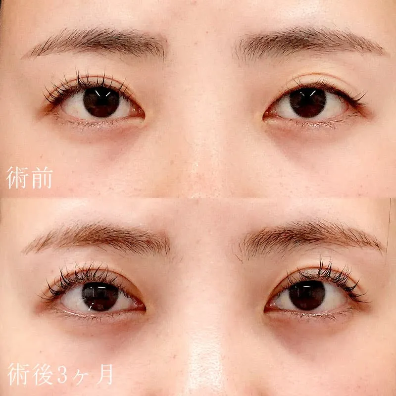 二重切開法の症例写真