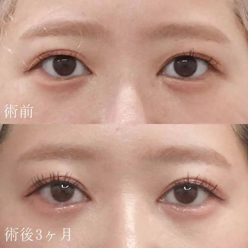 二重切開法の症例写真