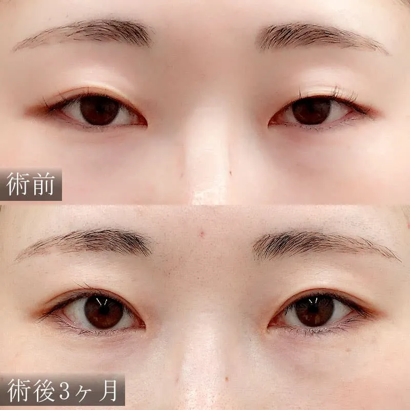 二重切開法の症例写真
