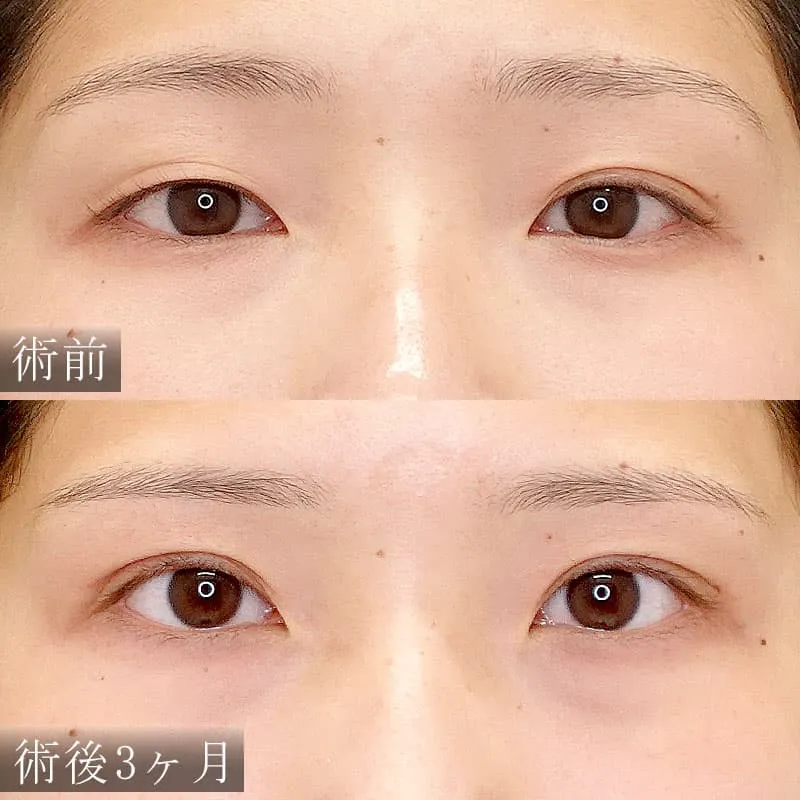 二重切開法の症例写真