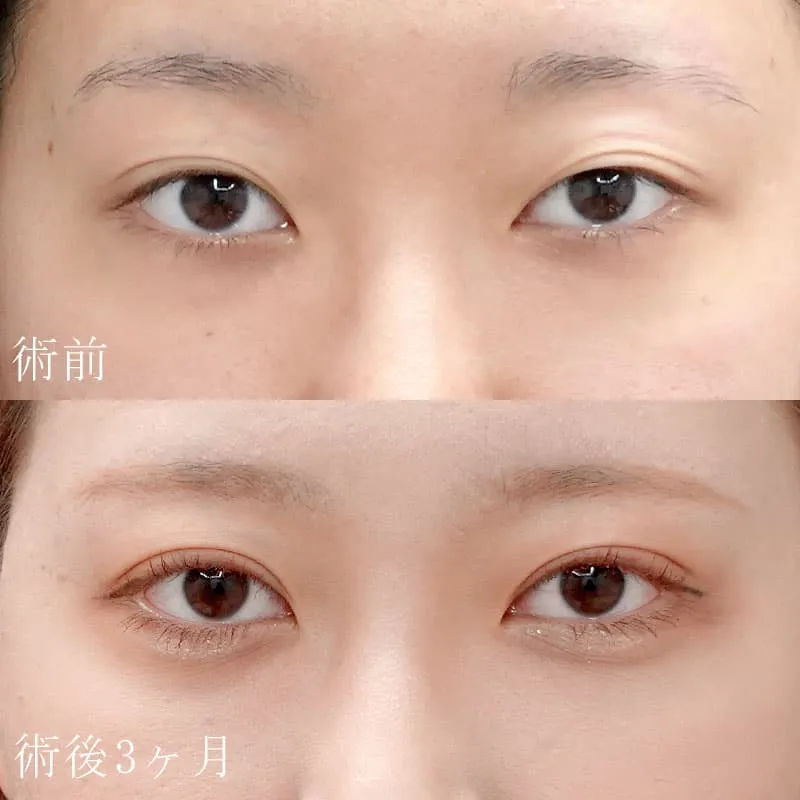 二重切開法の症例写真