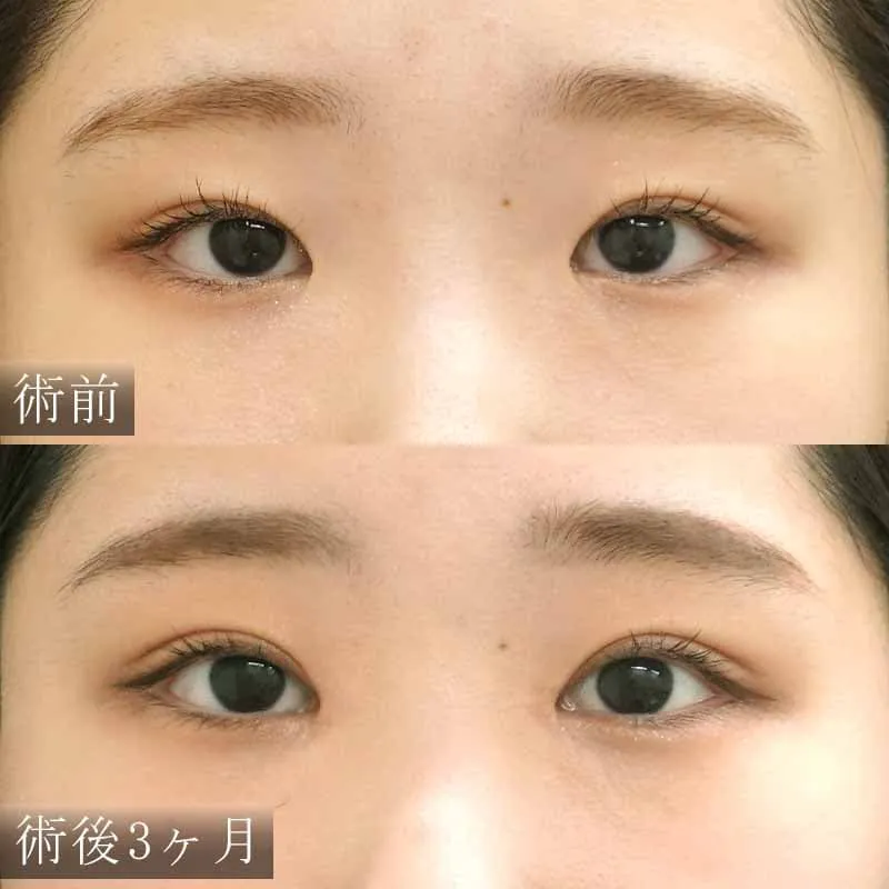 二重切開法・目頭切開の複合施術の症例