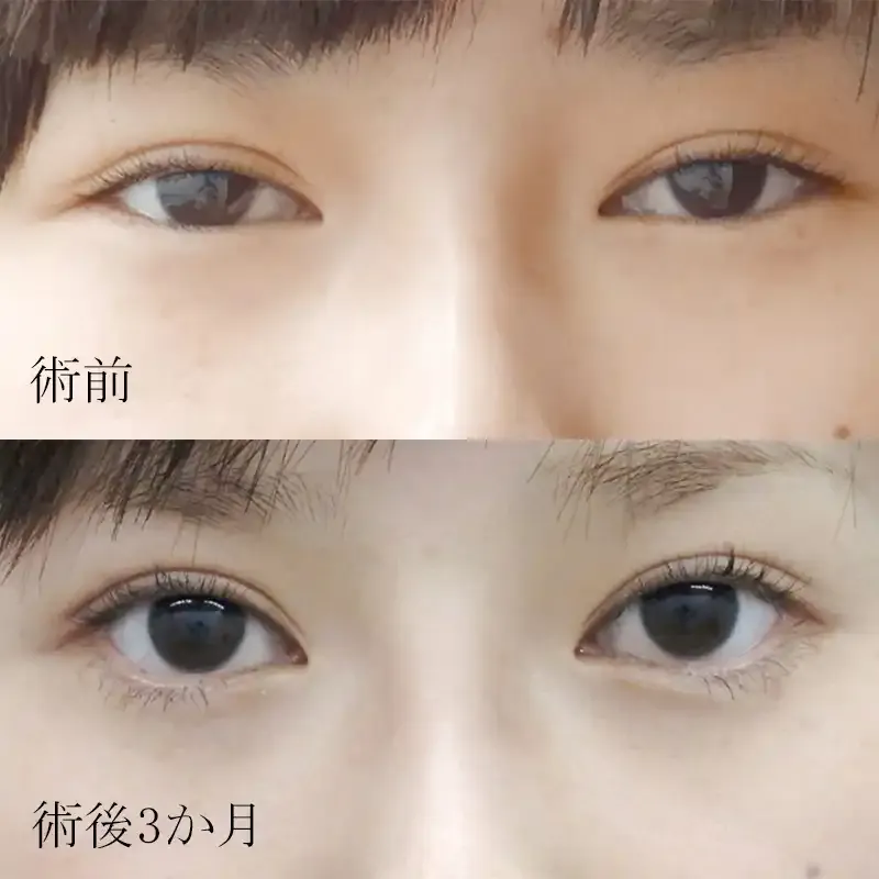 たれ目形成(グラマラスライン形成)の症例写真①