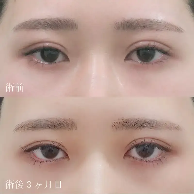たれ目形成(グラマラスライン形成)の症例写真③